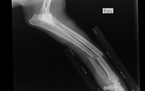 Nieuw biologisch afbreekbaar implantaat kan behandeling van fracturen veranderen